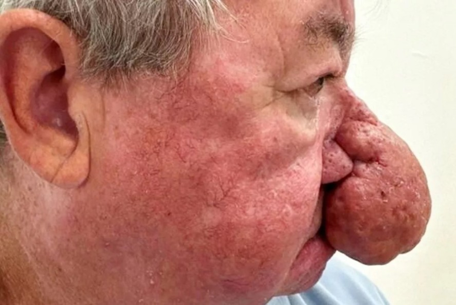 Escocês com nariz gigantesco se submete a cirurgia para poder voltar a beijar a esposa