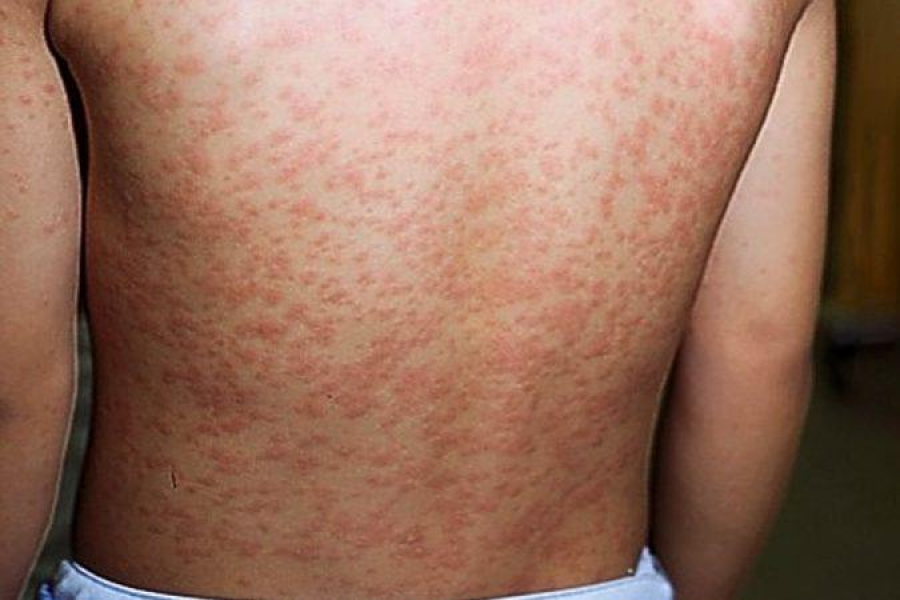 Negacionismo contra vacinas faz sarampo voltar com força total nas Américas; doença mata