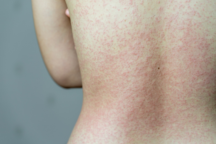 Casos com morres nas Américas colocam Acre em alerta contra o sarampo 